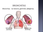 Bronchitas projektas 3