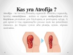 Raumenų atrofija 2