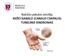 Nykščio pakylos atrofija 1